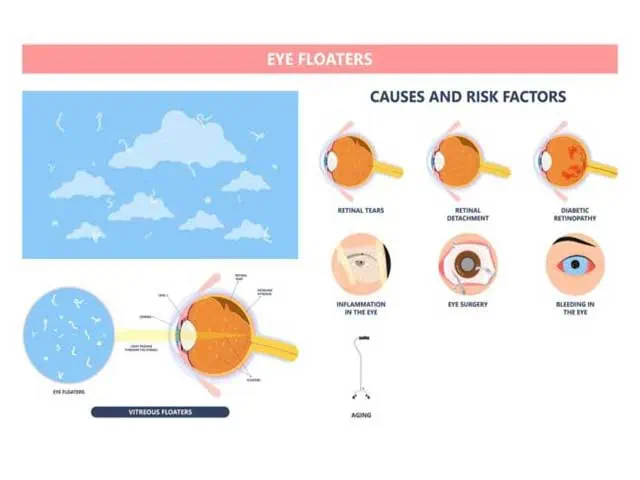 black-spots-in-your-eye-floaters